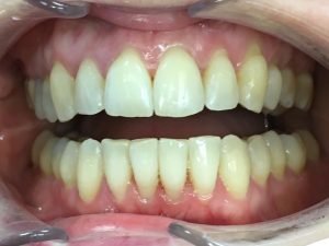 Invisalign voor & na