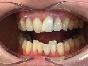 Invisalign voor & na